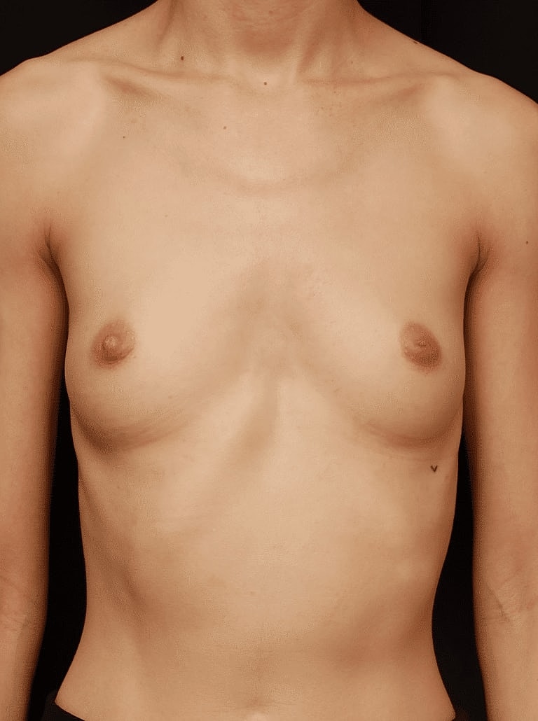 Breast Augmentation Before & After