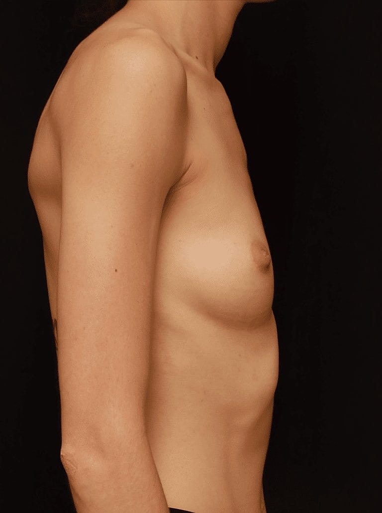 Breast Augmentation Before & After