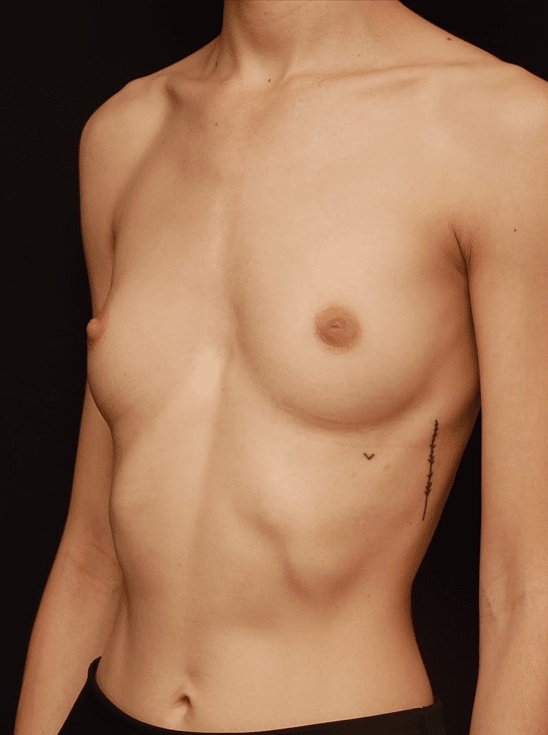 Breast Augmentation Before & After