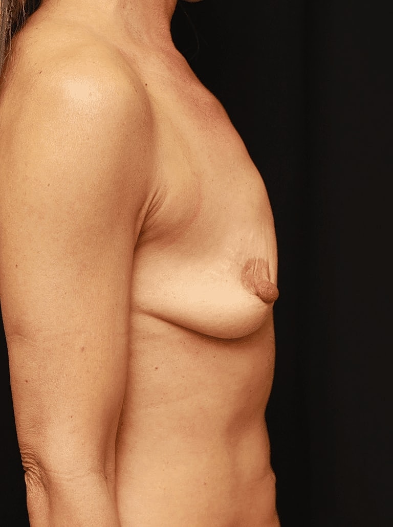 Breast Augmentation Before & After