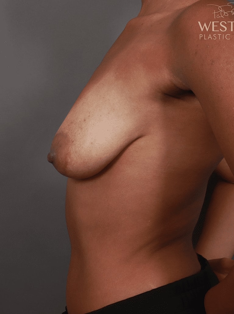 Breast Augmentation Before & After