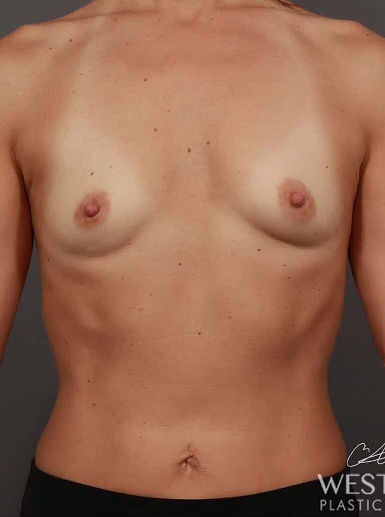 Breast Augmentation Before & After