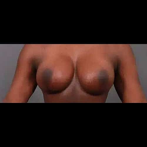 Breast Augmentation Before & After