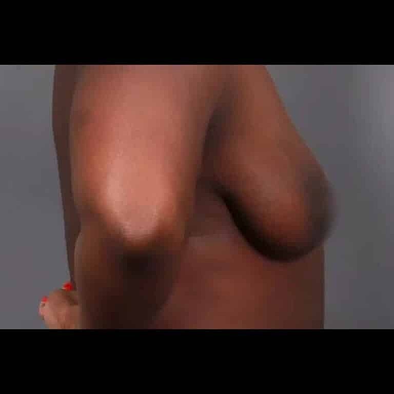 Breast Augmentation Before & After