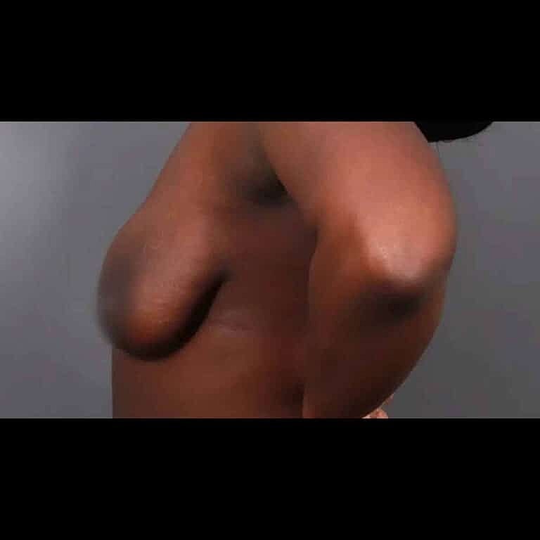 Breast Augmentation Before & After