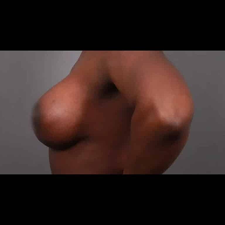 Breast Augmentation Before & After