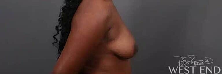 Breast Augmentation Before & After