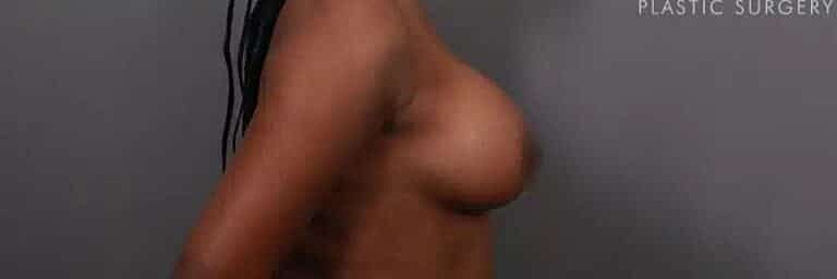 Breast Augmentation Before & After