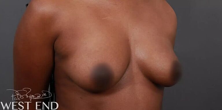 Breast Augmentation Before & After