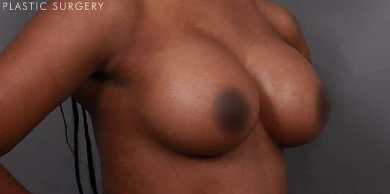 Breast Augmentation Before & After