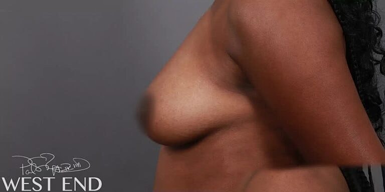 Breast Augmentation Before & After