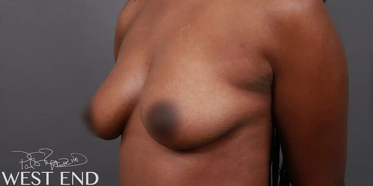 Breast Augmentation Before & After