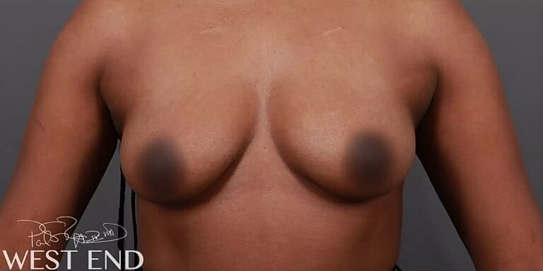 Breast Augmentation Before & After