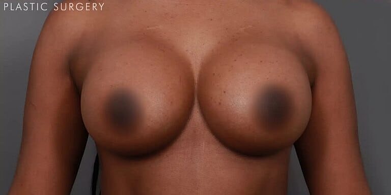 Breast Augmentation Before & After