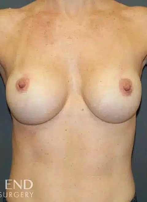 Breast Augmentation Before & After