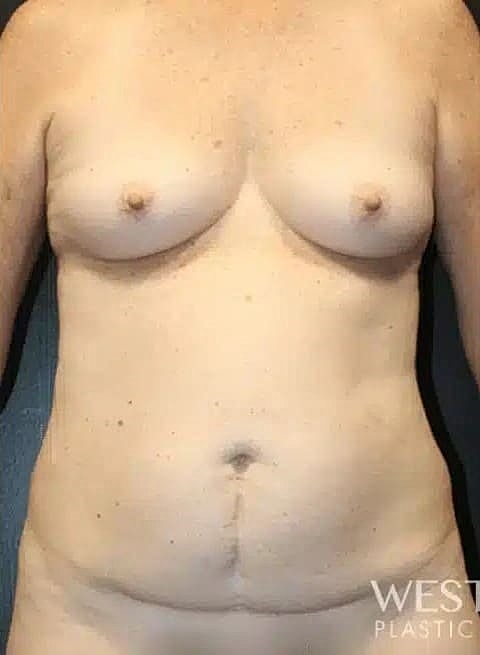 Breast Augmentation Before & After