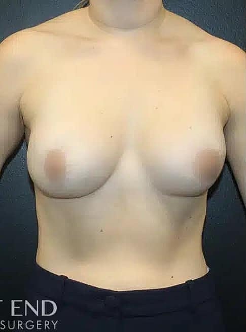Breast Augmentation Before & After