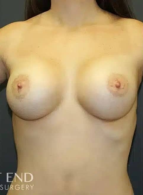 Breast Augmentation Before & After
