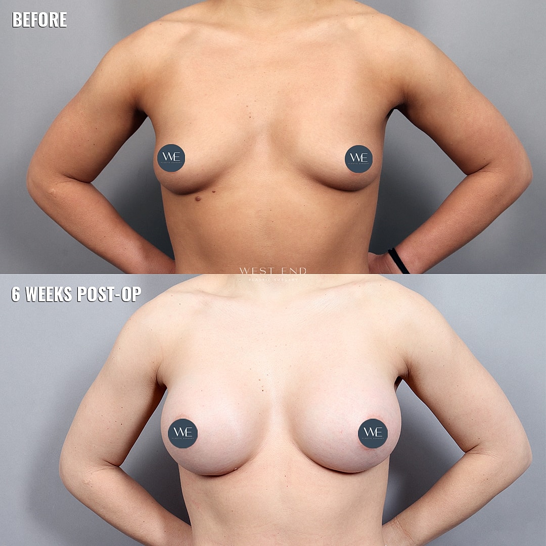 Breast surgery before and after results comparison.