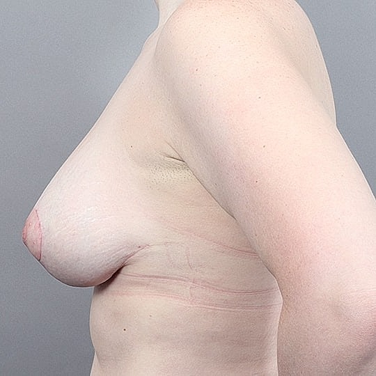 Breast Lift Before & After