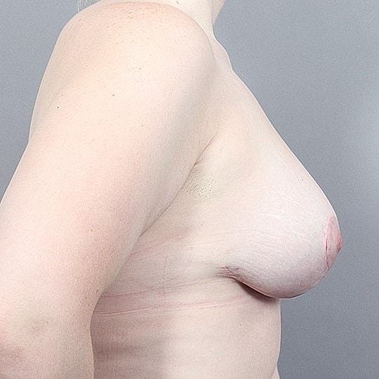 Breast Lift Before & After
