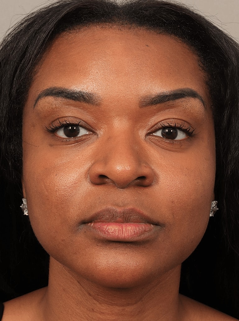 Neurotoxins Before & After