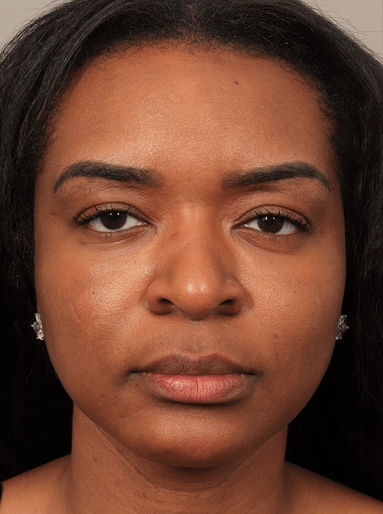 Neurotoxins Before & After