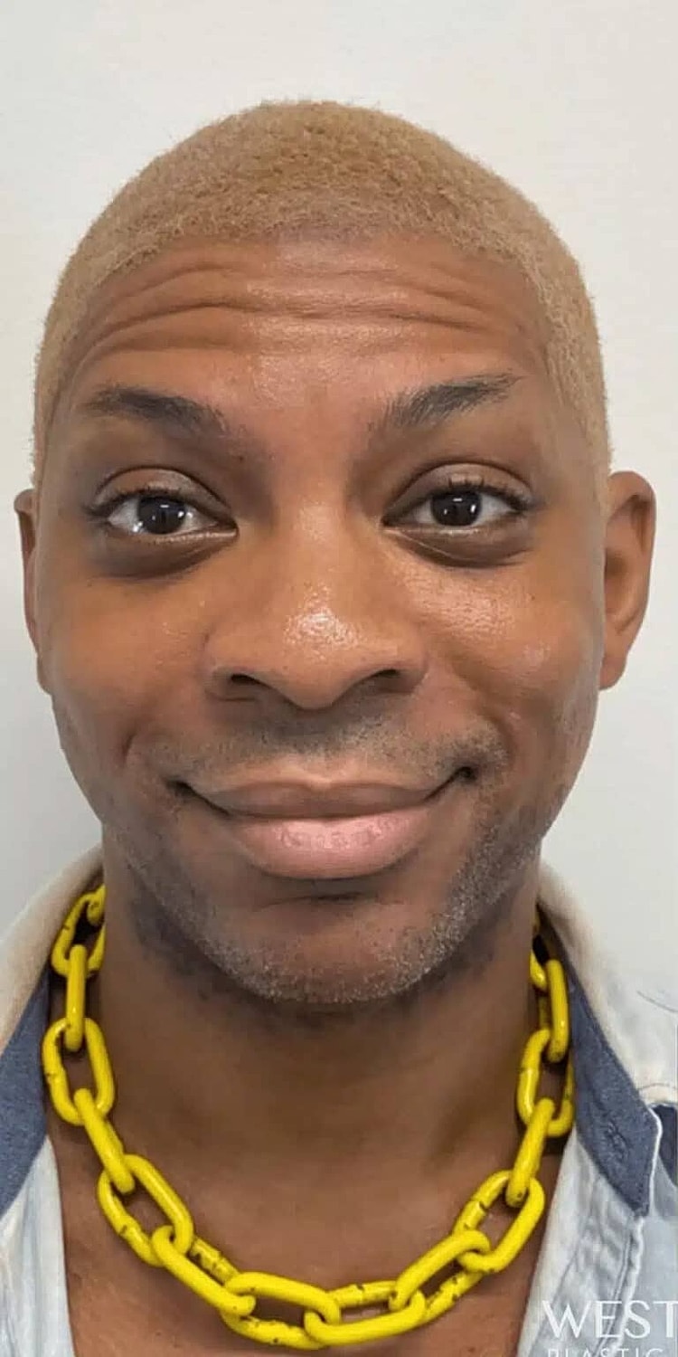 Neurotoxins Before & After