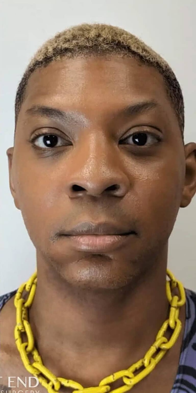 Neurotoxins Before & After