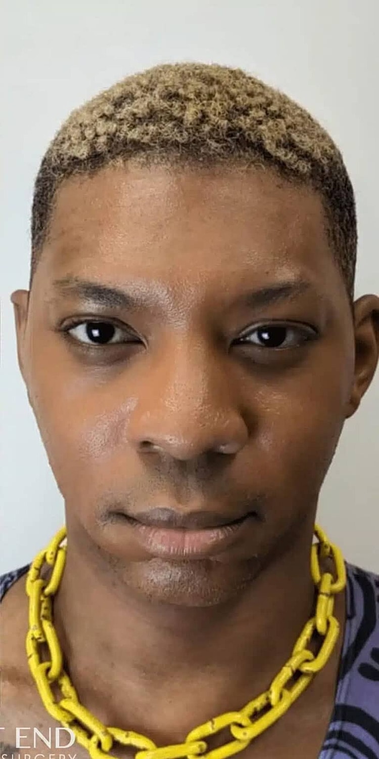 Neurotoxins Before & After