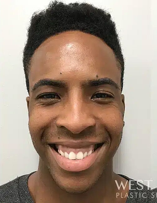 Neurotoxins Before & After