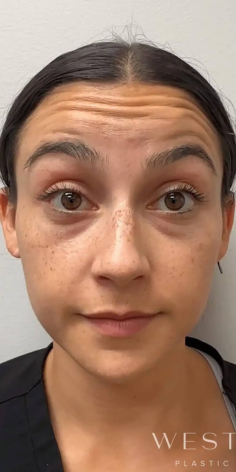 Neurotoxins Before & After