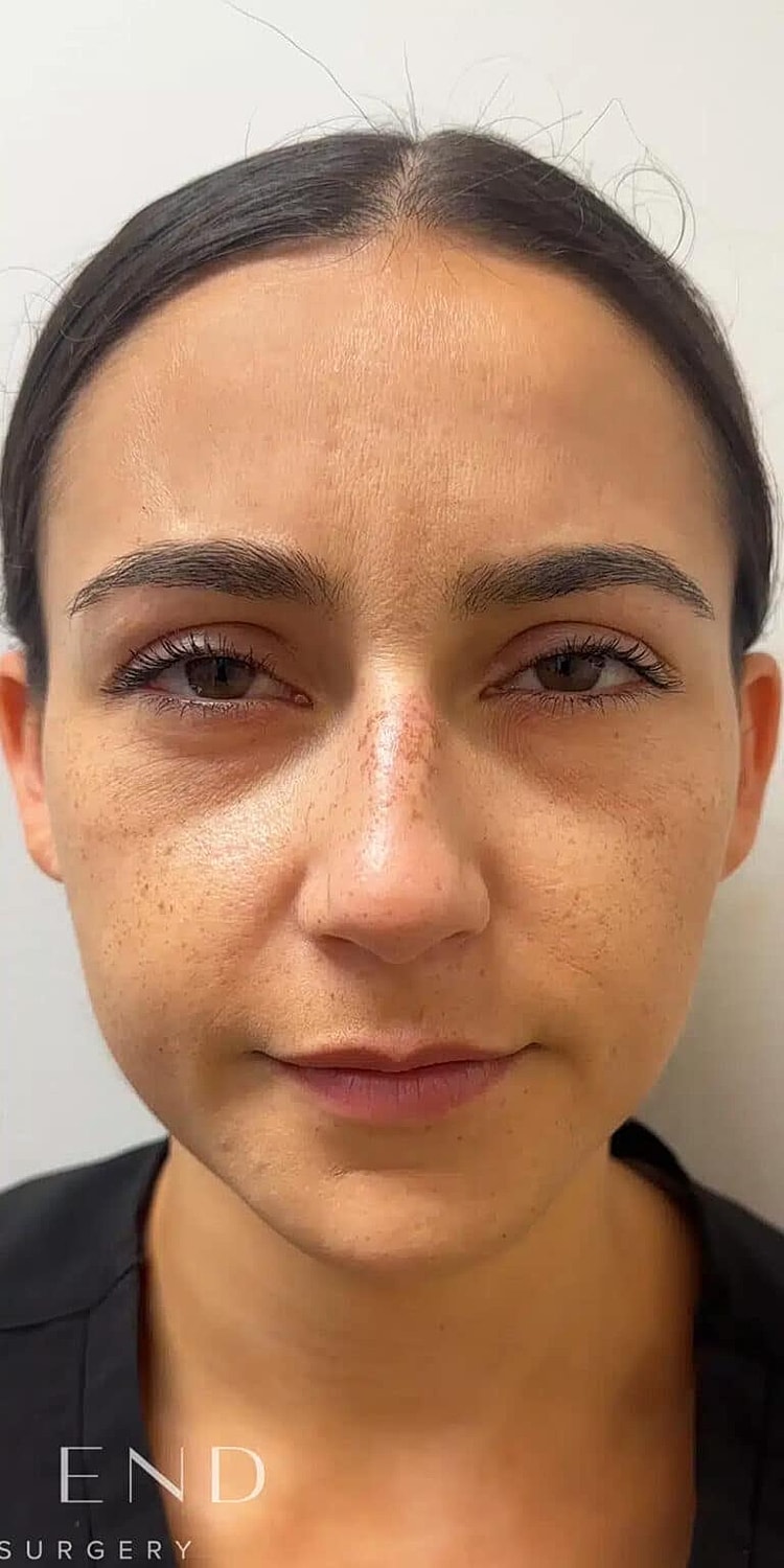 Neurotoxins Before & After