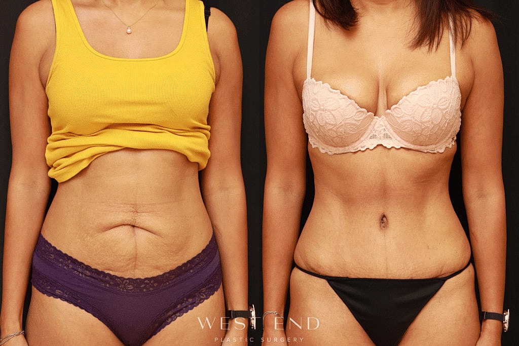 Before and after body transformation photo.