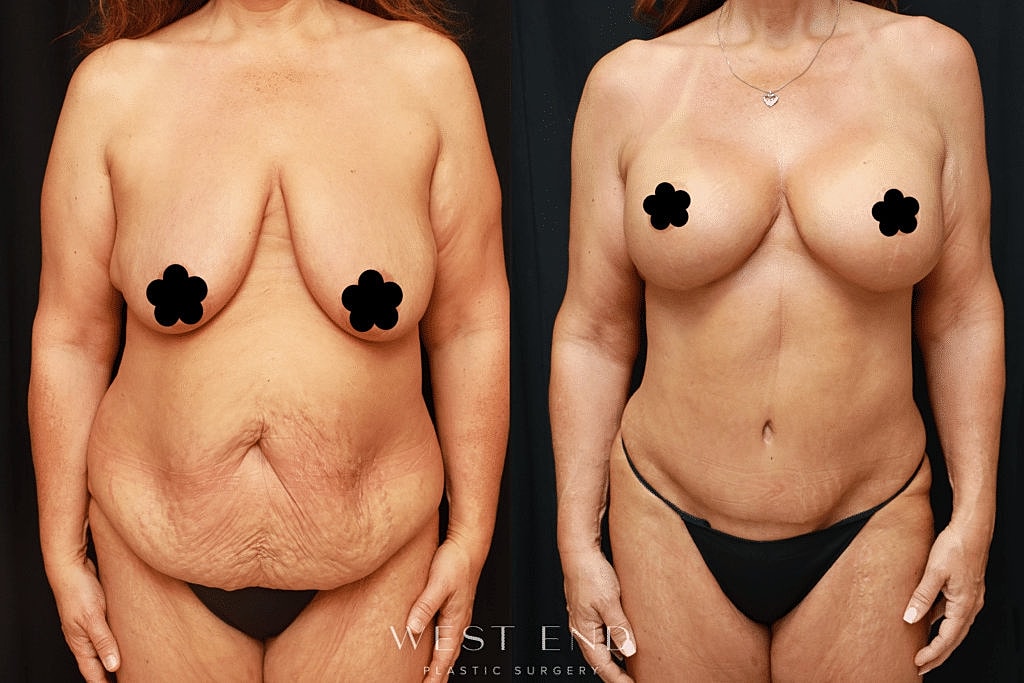 Before and after body transformation image.