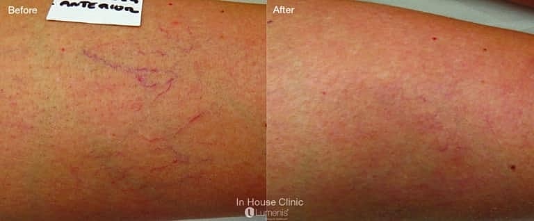 Before and after of IPL for Rosacea treatment Washington DC