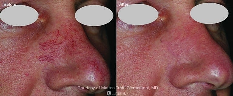 Before and after of Vein & Vascular Treatment with IPL Washington DC