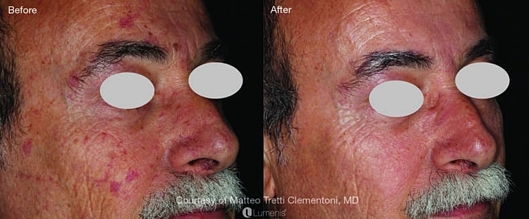 Before and After Image of IPL Treatment Washington DC