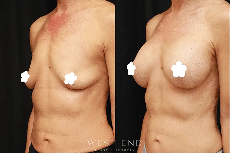 Before and after breast augmentation results.