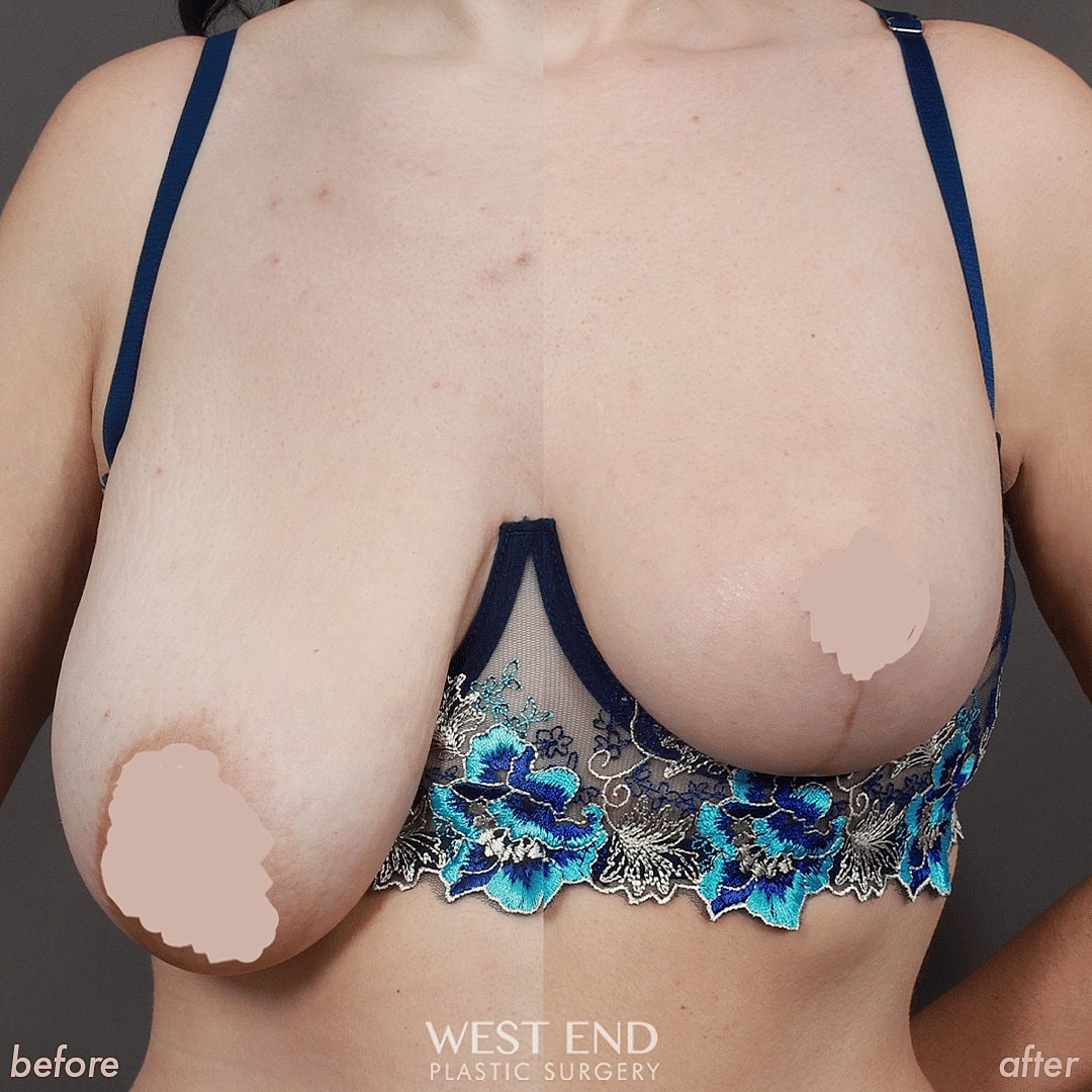 Breast Lift Surgery Washington dc