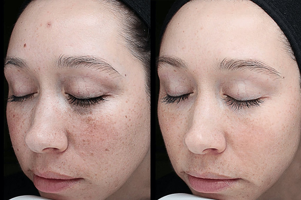 Before and after of VI Peels Treatment Washington DC