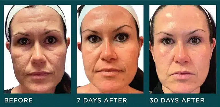 before and after BOTOX Injection treatment Washington DC