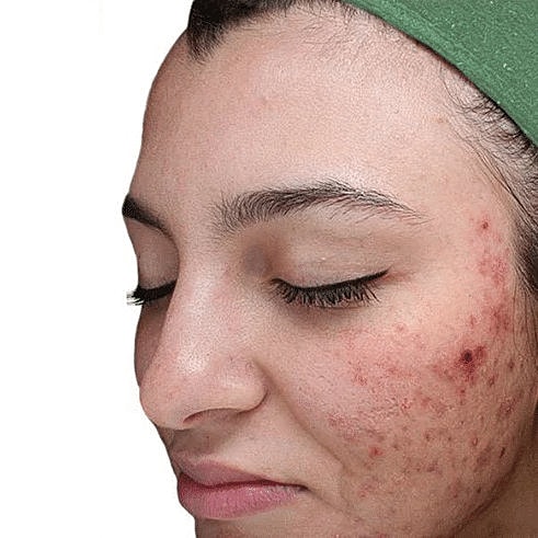 Before Image of IV Peel Washington DC