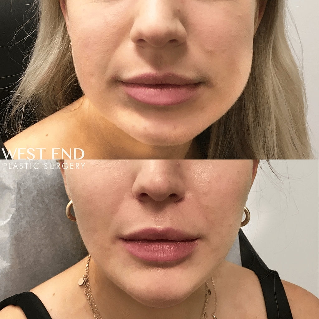 Lip enhancement before and after comparison photo.