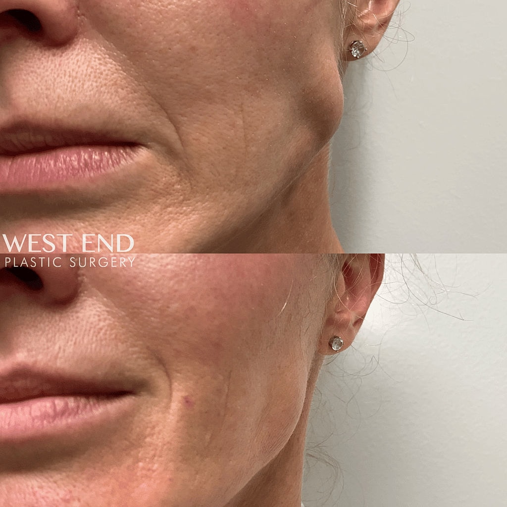 Before and after plastic surgery comparison.