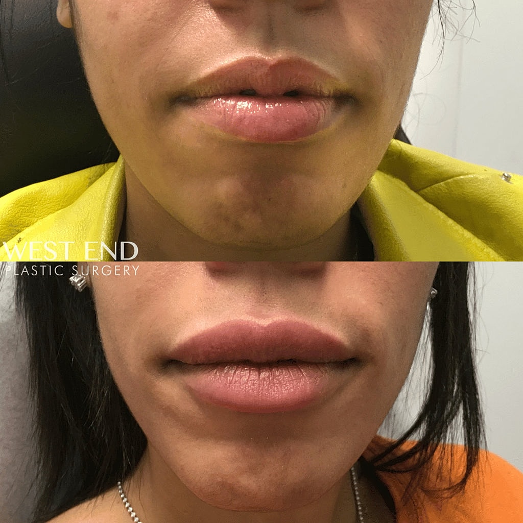 Before and after lip enhancement procedure.