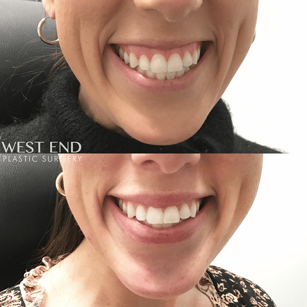 Before and after dental enhancement photos.