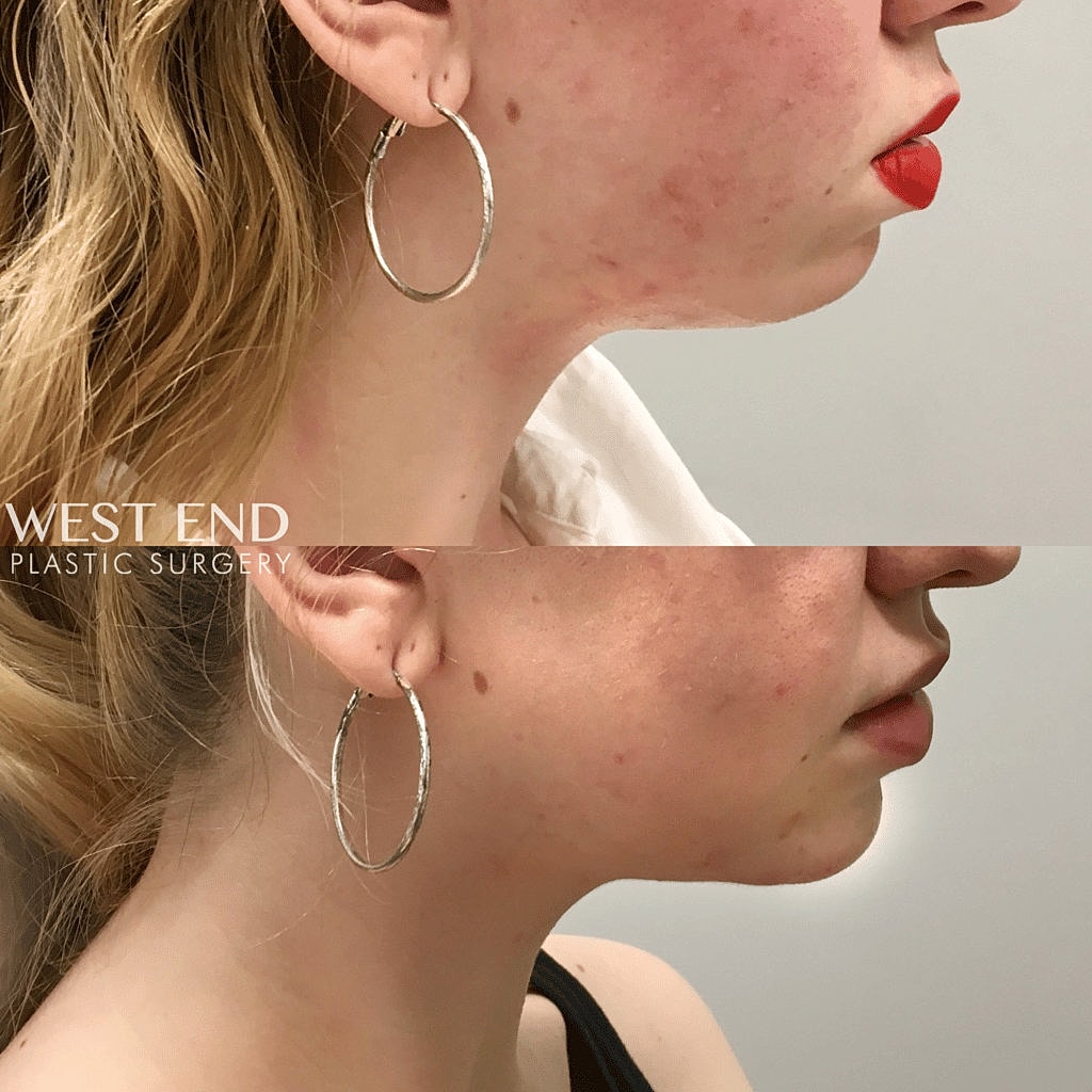 Before and after plastic surgery results comparison.