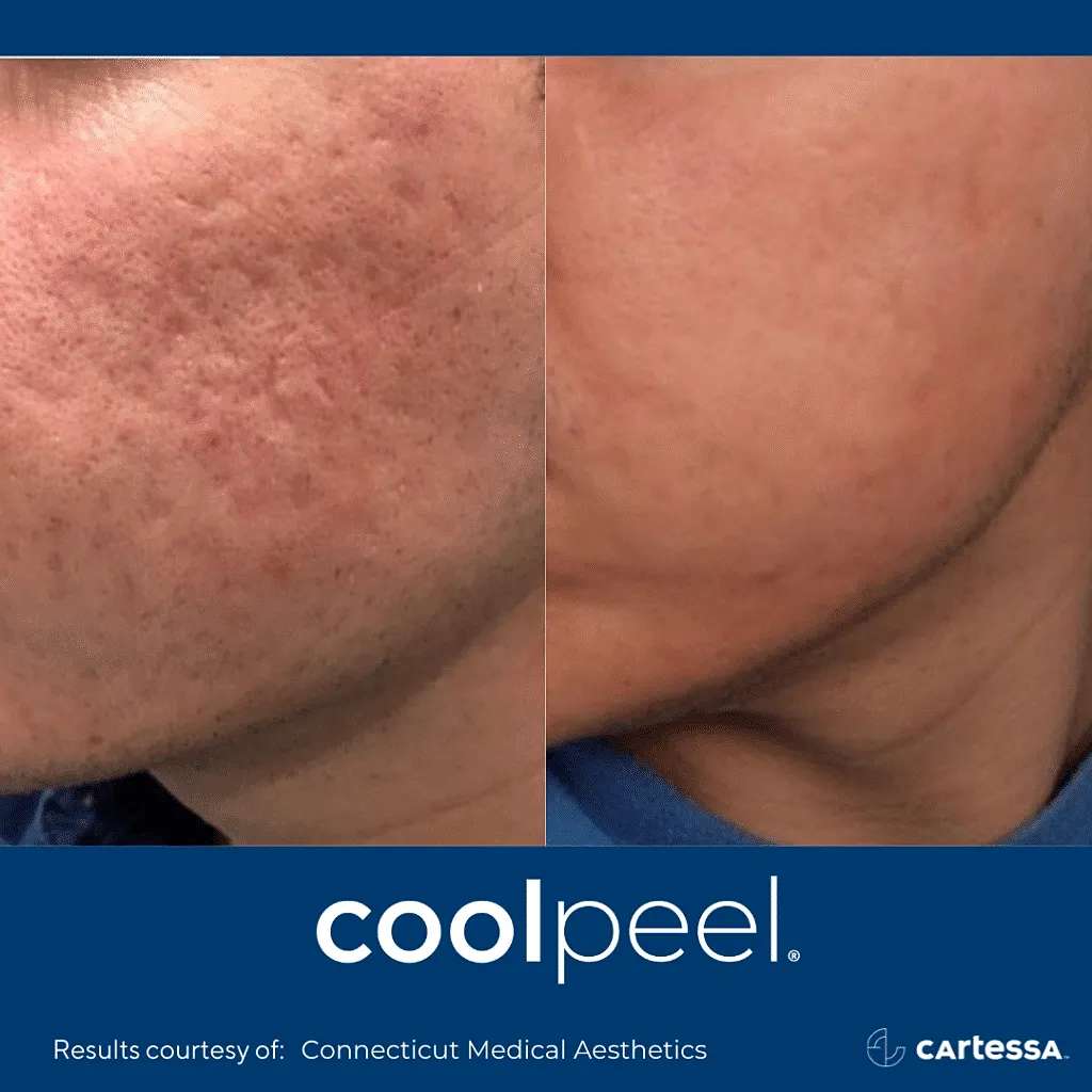 Tetra CoolPeel CO2 Before & After Washington DC