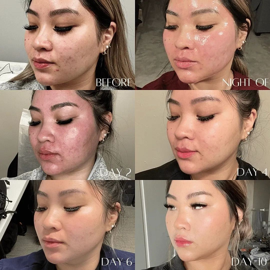 Tetra CoolPeel CO2 Washington DC